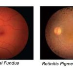 retinite-pigmentosa-fondo