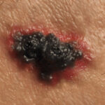 Melanoma