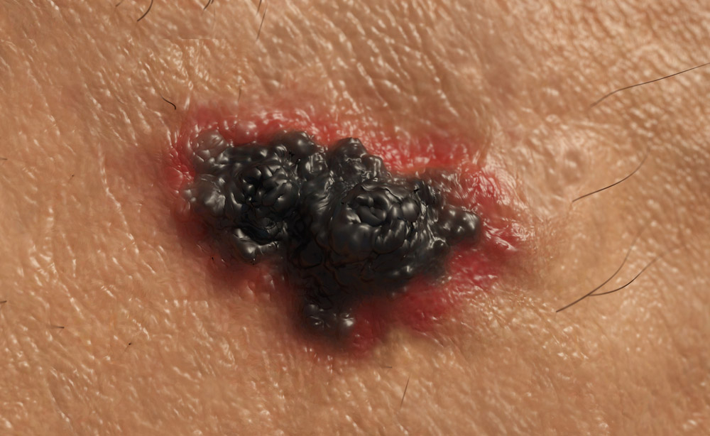 Nel melanoma, la radiochirurgia può combinarsi bene con l’immunoterapia melanoma