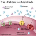 type_1_diabetes