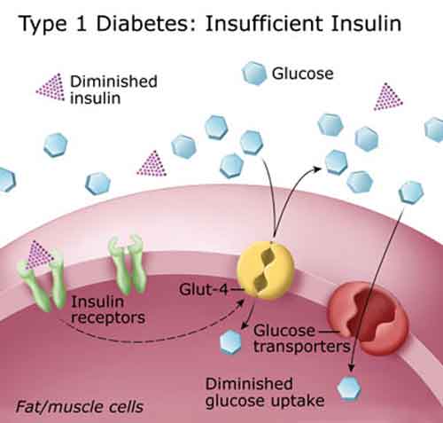 Diabete di tipo 1: dopo sette anni, la produzione di insulina si stabilizza diabete di tipo 1