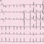 AF_with_RVR-Ashmans_phenomenon-RBBB_aberrancy