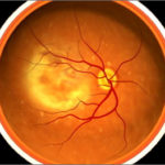AMD-retina-ok