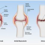 Artritesfhaeth