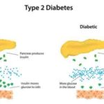Type-2-Diabetes