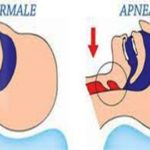 apnee