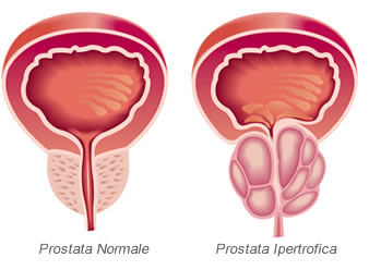 Tumore alla prostata sintomi