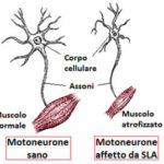motoneuroni-sla