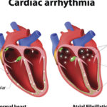 xscompenso,P20cardiaco_thumb_720_480.jpg.pagespeed.ic.BIqaR-Ng6B