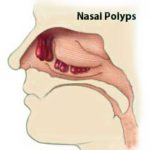 Nasal-Polyps