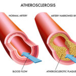 atherosclerosis