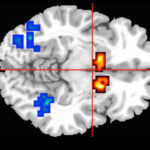 brain-scan-image-430x275