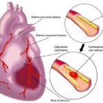 infarto-arresto-cardiaco