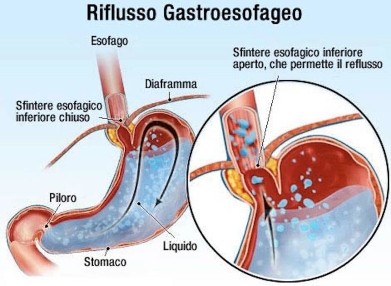 Trattamento per il bruciore di stomaco previene il cancro dell'esofago