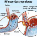 reflusso-gastroesofageo