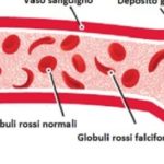 lanemia-falciforme-e-ancora-oggi-una-malattia-incurabile-di-recente-e-stato-segnalato-il-primo-caso-di-guarigione-con-una-terapia-sperimentale_1442347