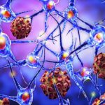 sclerosi_multipla_47321