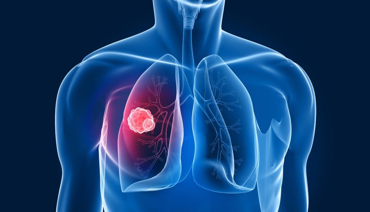 L’ablazione termica tratta efficacemente il cancro del polmone in stadio iniziale ablazione termica