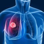 tumori-_in_italia_nuova_immunoterapia_contro_il_cancro_al_polmone_-e1534182424567