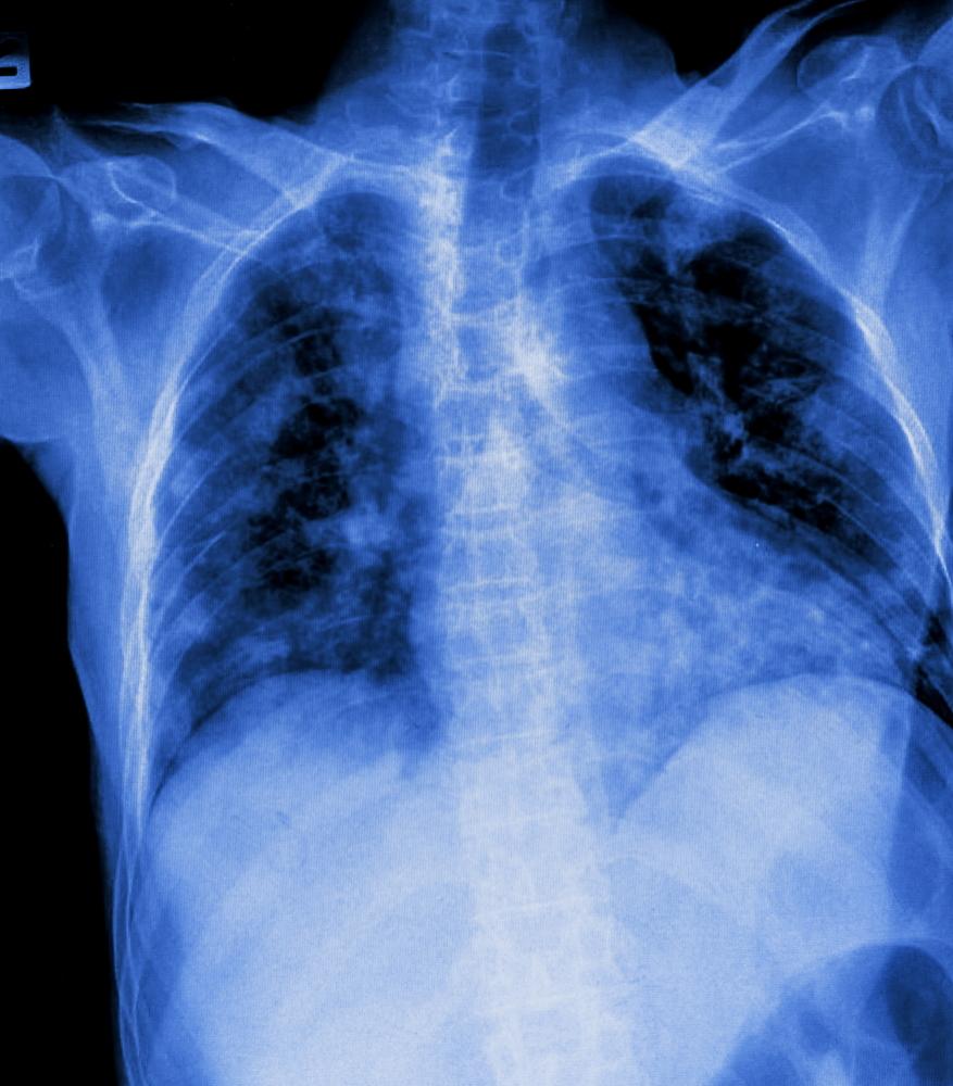Radiografia_fibrosi_polmonare