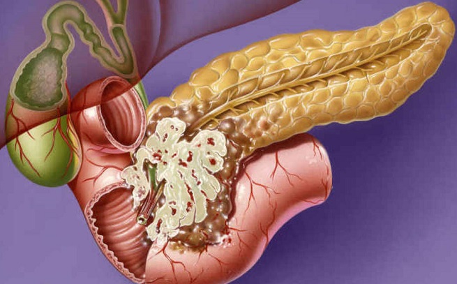 Perché alcuni tipi di cancro del pancreas colpiscono solo le giovani donne cancro del pancreas