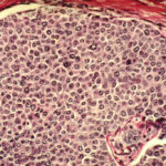 Breast_cancer_cells-1024x683