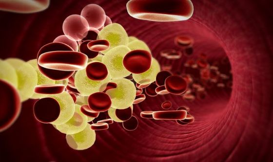 Gestire il colesterolo potrebbe prevenire l’ Alzheimer ? alzheimer