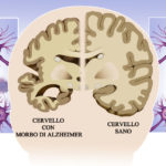 Alzheimer_gallery_introduzione