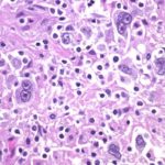 LINFOMA