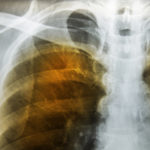 Lung Feature