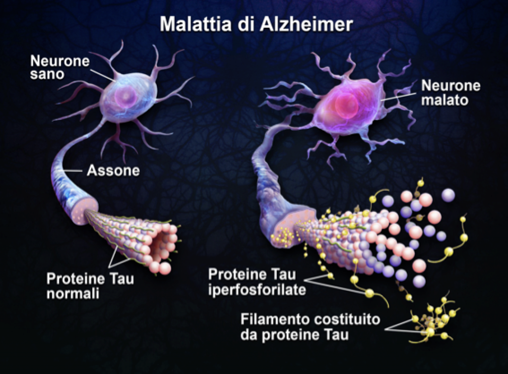 Identificato l’inizio molecolare dello sviluppo dell’Alzheimer alzheimer