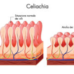 content_celiachia-spiegazione