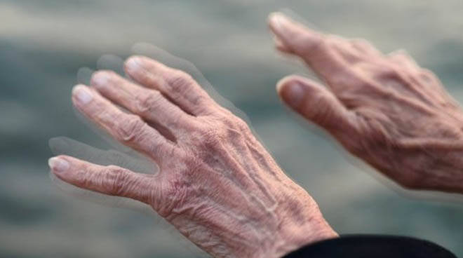 Parkinson, identificato nuovo bersaglio terapeutico parkinson