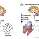 parkinson