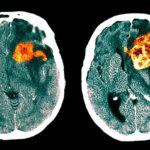 Diagnosis-of-Glioblastoma-RM-722x406