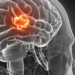 NYP-Gioblastoma-photo_1200x500px