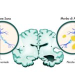content_alzheimer_neuroniconplacche