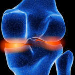 osteoartrosi