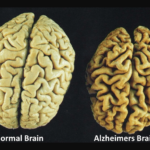 alzheimer-brain