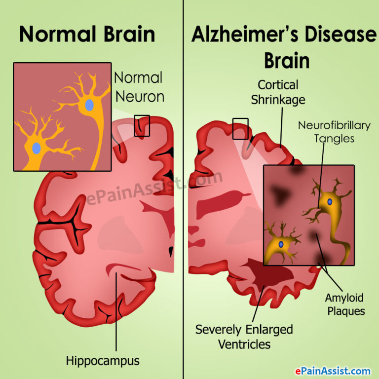 Alzheimer, individuato nuovo responsabile del declino cognitivo alzheimer