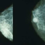 breastcancer