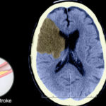 cervello_stroke_ischemico_77581