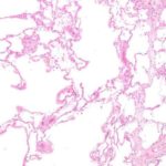 copd