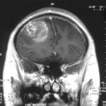 1-glioblastoma