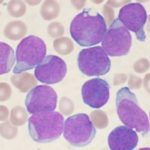 leucemia