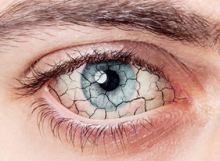 Malattia dell’occhio secco e diabete diabete