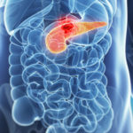 tumore-pancreas