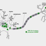 Agrégats-de-TDP43-dans-le-neurone