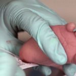 immunodeficienza-combinata-grave