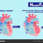 heart failure concept